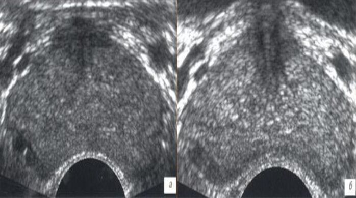 Echografie voor en na behandeling met druppels Prostovit